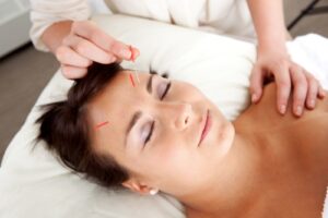 stress and acupuncture