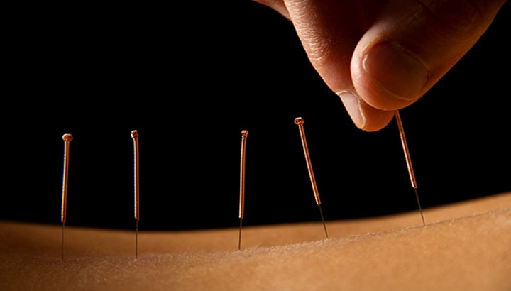 Best Acupuncture services