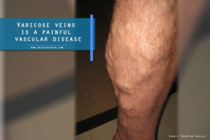 Varicose veins is a painful vascular disease