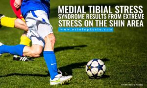 Medial tibial stress syndrome results from extreme stress on the shin area