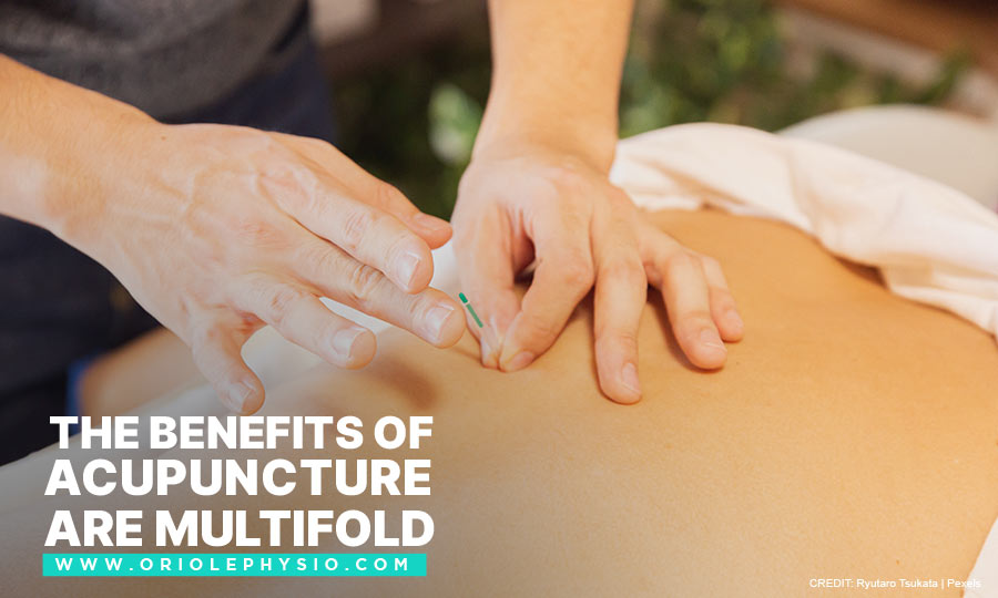 The benefits of acupuncture are multifold
