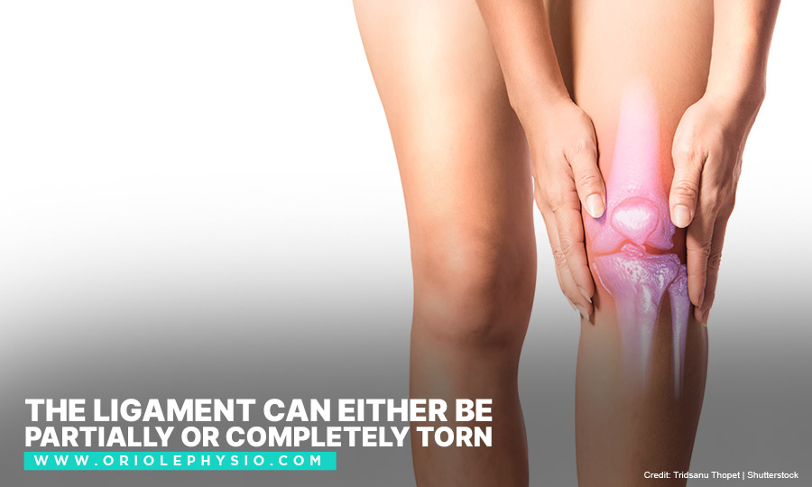 The ligament can either be partially or completely torn