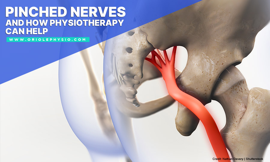 Pinched Nerves and How Physiotherapy Can Help