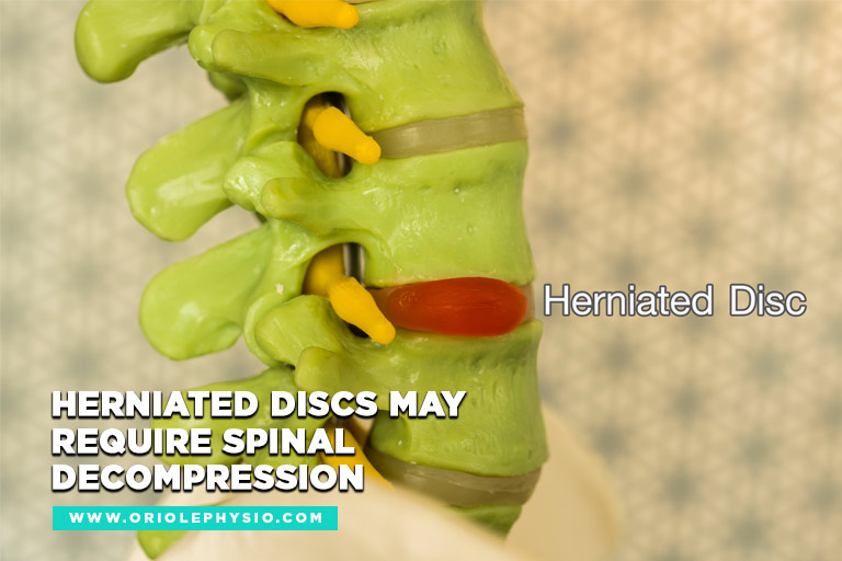 Herniated discs may require spinal decompression