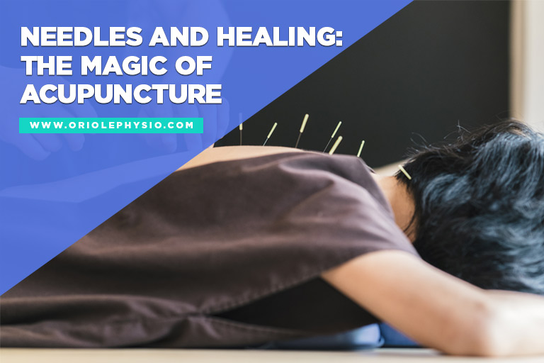 Needles and Healing: The Magic of Acupuncture