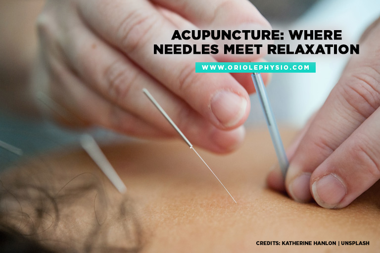 Acupuncture: Where needles meet relaxation
