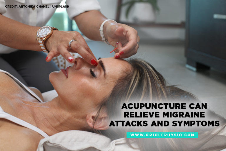 Acupuncture can relieve migraine attacks and symptoms.